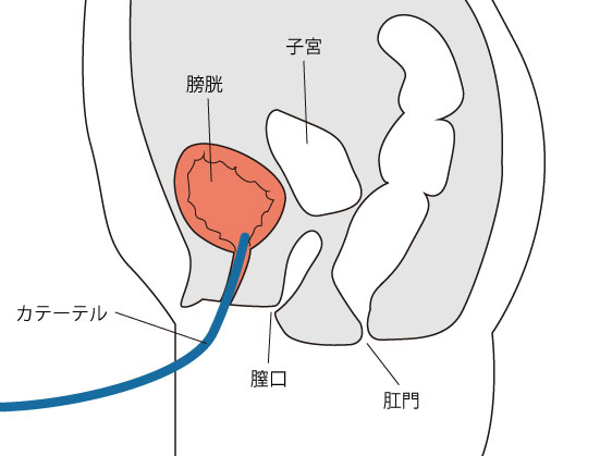 導尿,女性,膀胱,尿道断面図