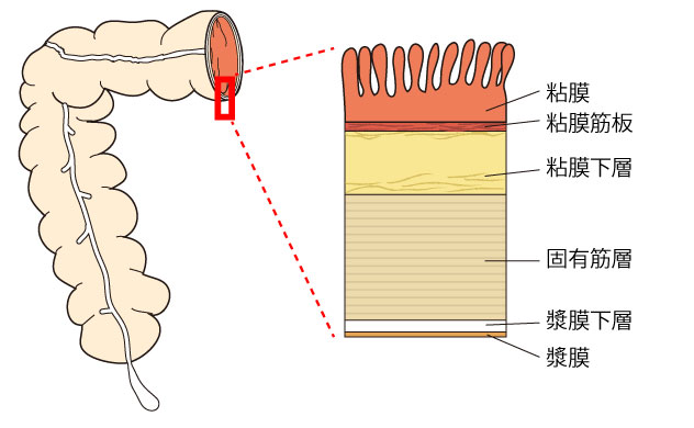大腸がん、粘膜、粘膜筋板、粘膜下層、固有筋層、漿膜