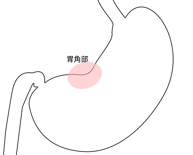 胃角部