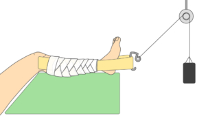 点滴ラインの準備 点滴静脈内注射の刺入 看護学生レポート